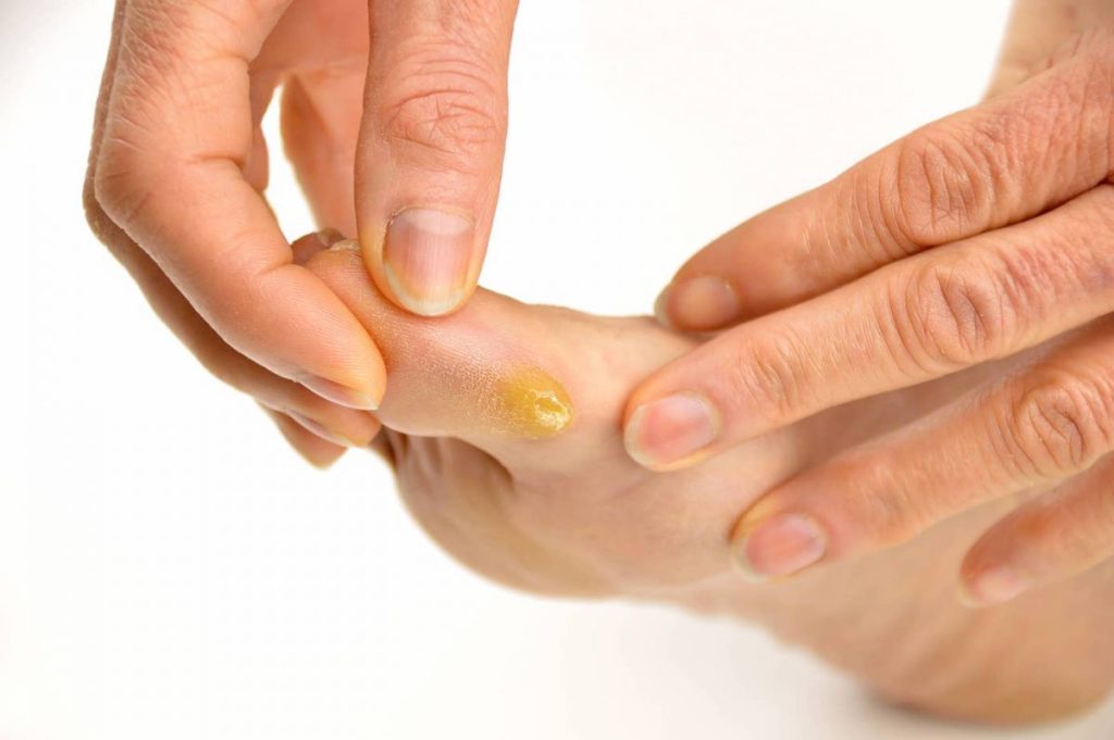 5 Callus Removal Mistakes to Avoid: Protect Your Skin and Feet 5 Callus Removal Mistakes to Avoid