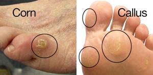 Revitalize Foot Calluses and Dry Skin: Expert Tips for Healthier Feet (Guide 2025) Foot Calluses and Dry Skin