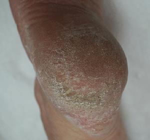 Revitalize Foot Calluses and Dry Skin: Expert Tips for Healthier Feet (Guide 2025) Foot Calluses and Dry Skin