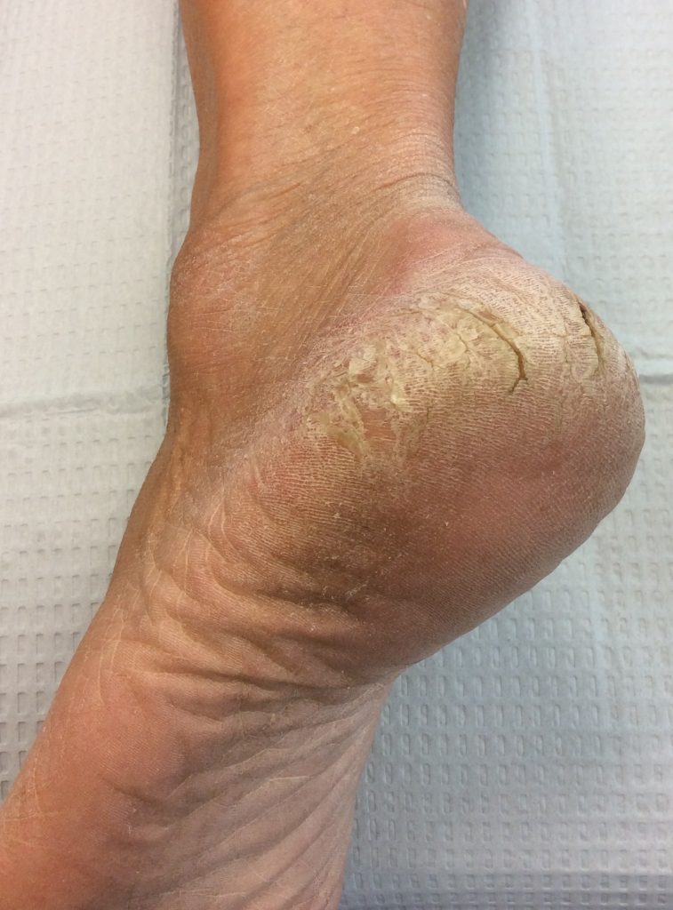 When to See a Podiatrist for Severe Calluses: 5 Warning Signs (2025) Severe Calluses