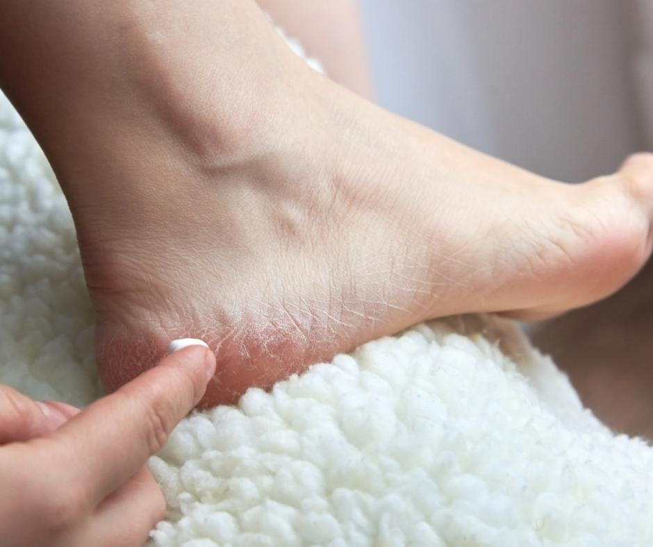 Essential Winter Foot Care: Tips for Sports and Outdoor Activities (Guide 2025) Winter Foot Care