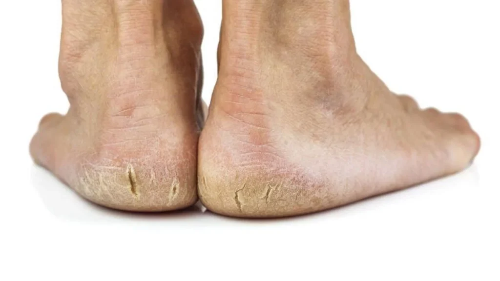 Foot Buffing: 7 Easy Steps for Silky-Smooth Soles Causes of Dead Skin on Feet / foot Buffing