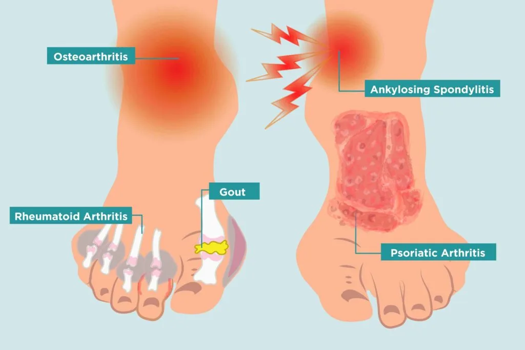 To Relieve Foot Pain: Best Tips and Remedies for Quick Relief (2025) To Relieve Foot Pain